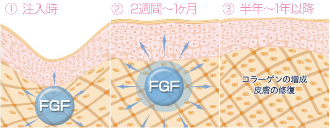 FGF（線維芽細胞増殖因子）注入のしくみ