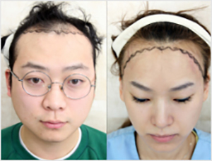 FUT植髮技術說明-我院有男性脫髮症，女性髮際線。