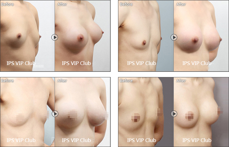 隆胸整形-自體脂肪移植隆胸