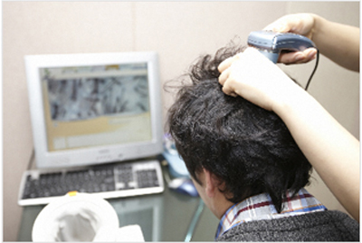植髮手術過程-移植部位的設計和加工密度的測定