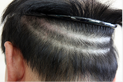 植髮手術過程-後枕部的毛髮整理