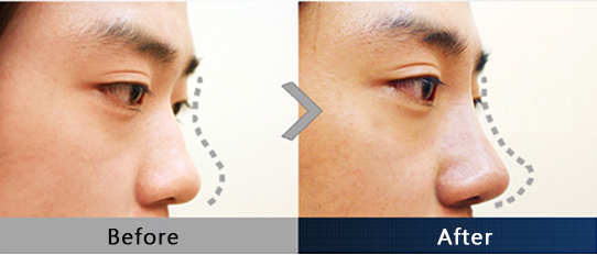 HIKO隆鼻術-線如何讓鼻子挺拔？
